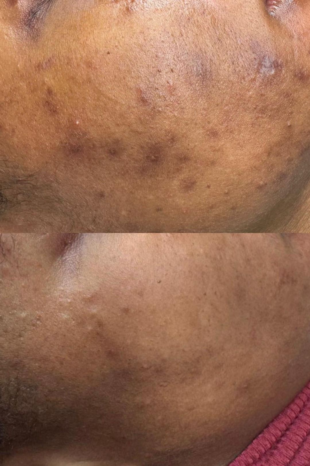 421 Black Peel after treatment